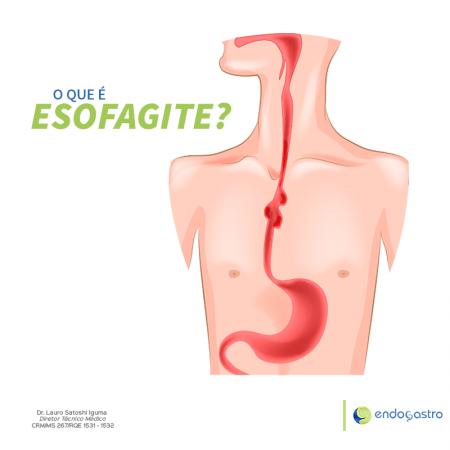 O que é Esofagite