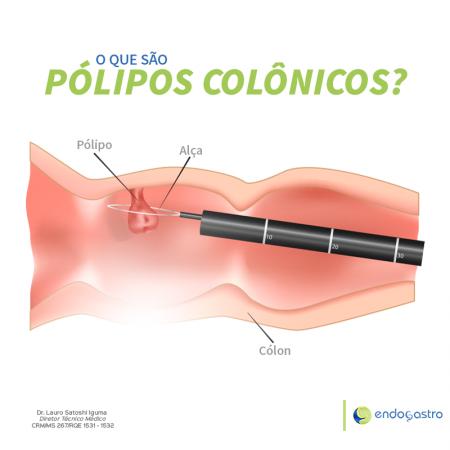 O que são Pólipos Colônicos
